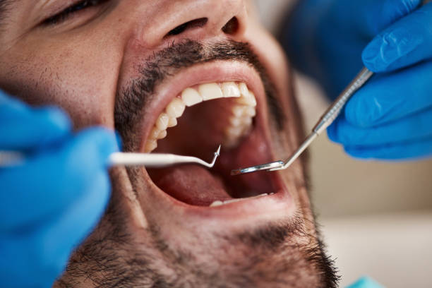 Best Knocked-Out Tooth (Avulsed Tooth) Treatment in Larkfield Wikiup, CA