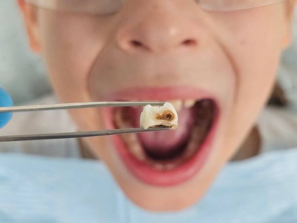 Best Emergency Care for Gum Disease in Larkfield Wikiup, CA